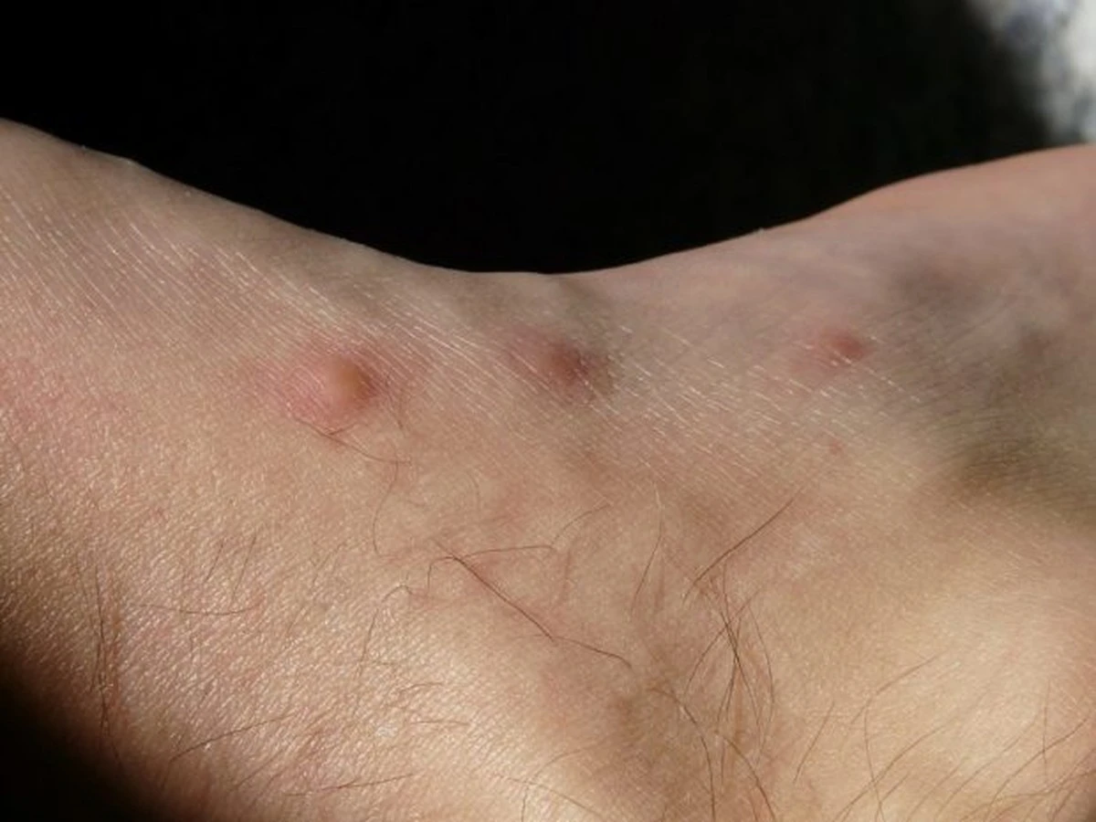 3 kroky, jak správně reagovat po kousnutí klíštětem – zachraňte své zdraví - image 2