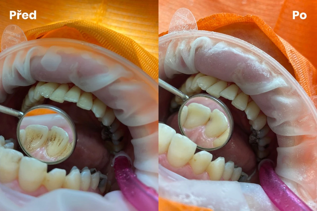 Jen pětina Čechů řeší dentální hygienu pravidelně. Děti na ni chodí pozdě - image 1