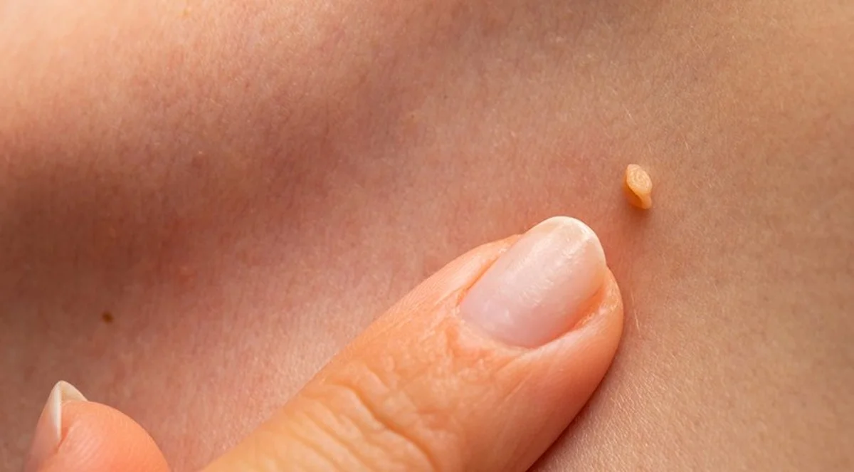 Chcete se zbavit bradavic? Důležité tipy od odborníků, které vám ušetří čas i bolest. - image 1