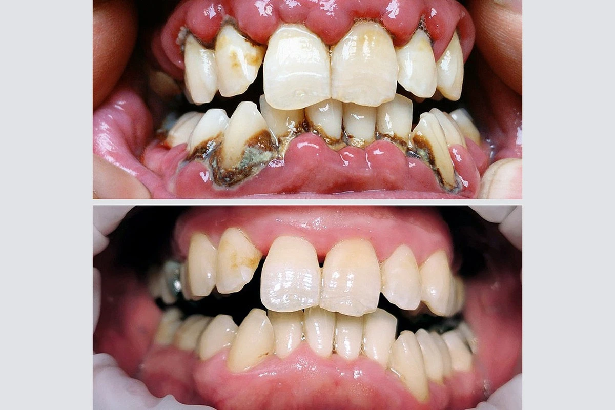 cistenizubupred-extra-1.webp Čištění zubů: Před nebo po snídani? Konečně víme, co je správně - image 1