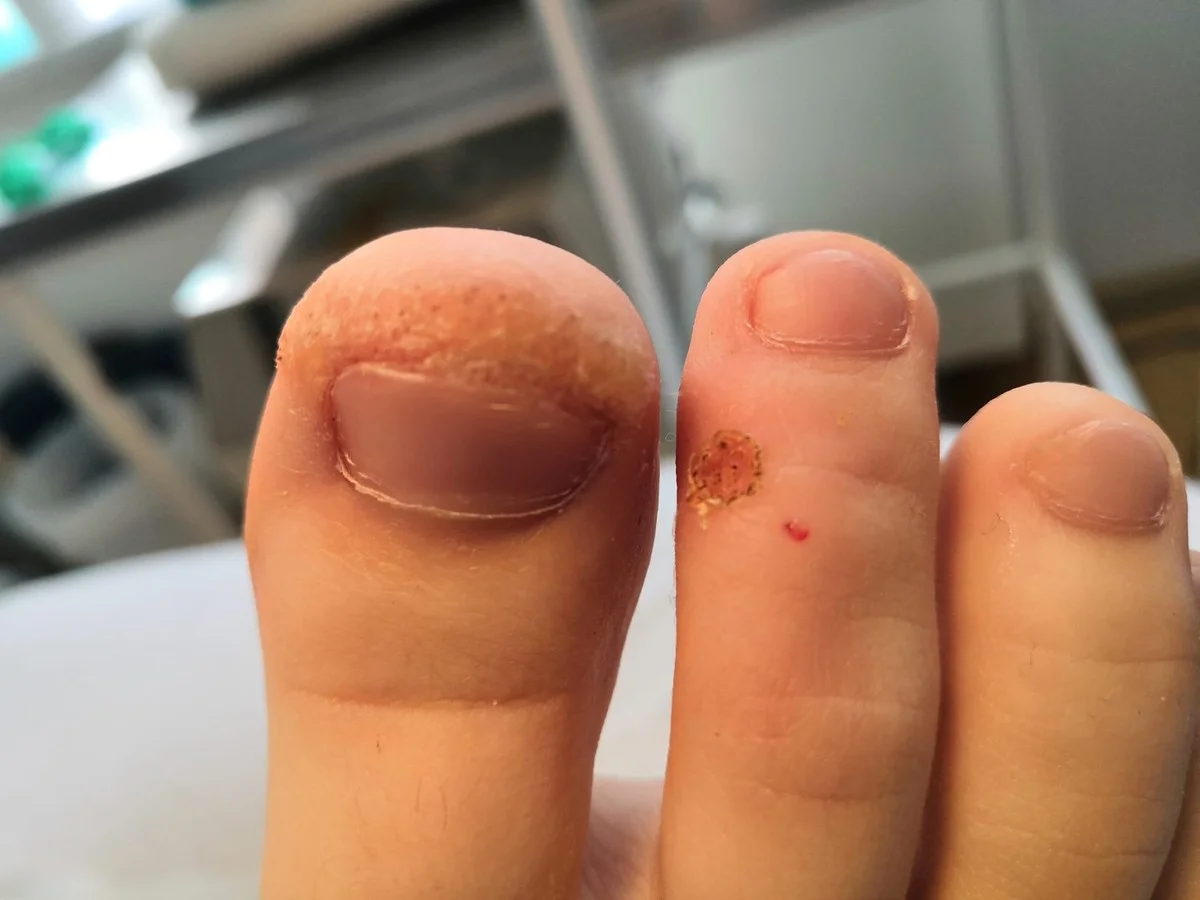 Chcete se zbavit bradavic? Důležité tipy od odborníků, které vám ušetří čas i bolest. - image 2