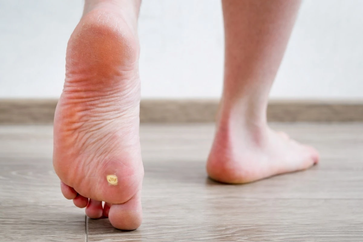 Bradavic zbavíte snadno: Jarní checklist pro čistou pokožku