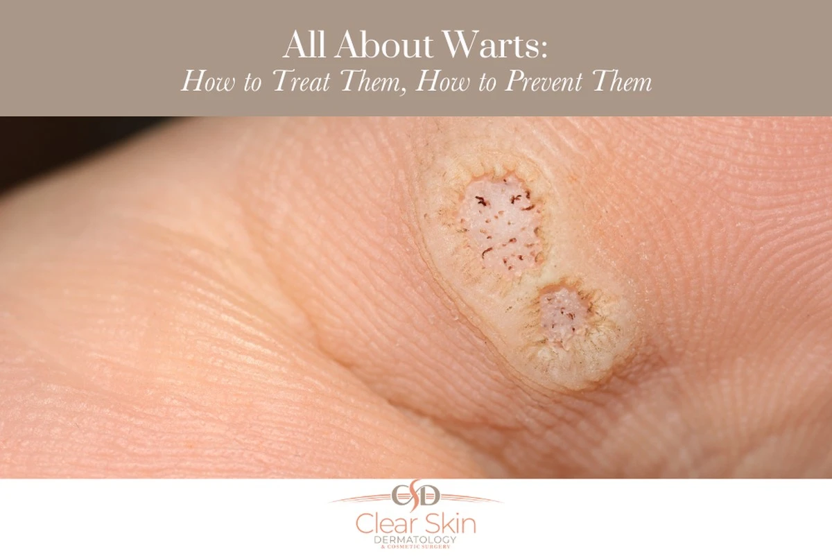 Proč bradavice ignorujeme i přes jejich častý výskyt - image 1